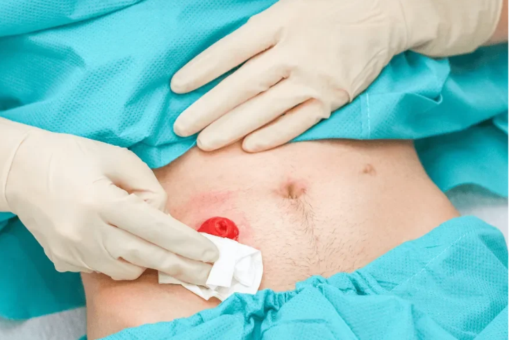 Hernia Surgery