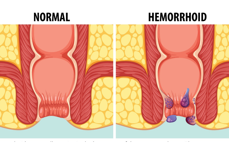 Haemorrhoidopexy
