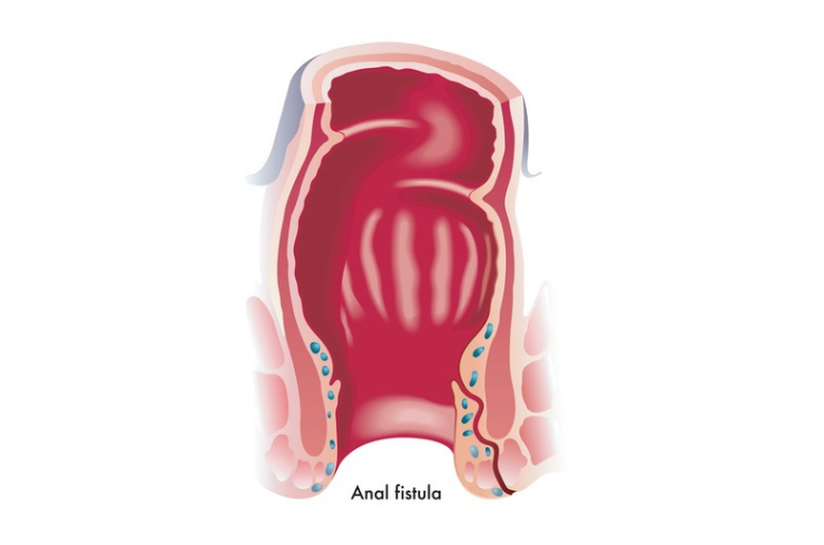 Fistula Treatment
