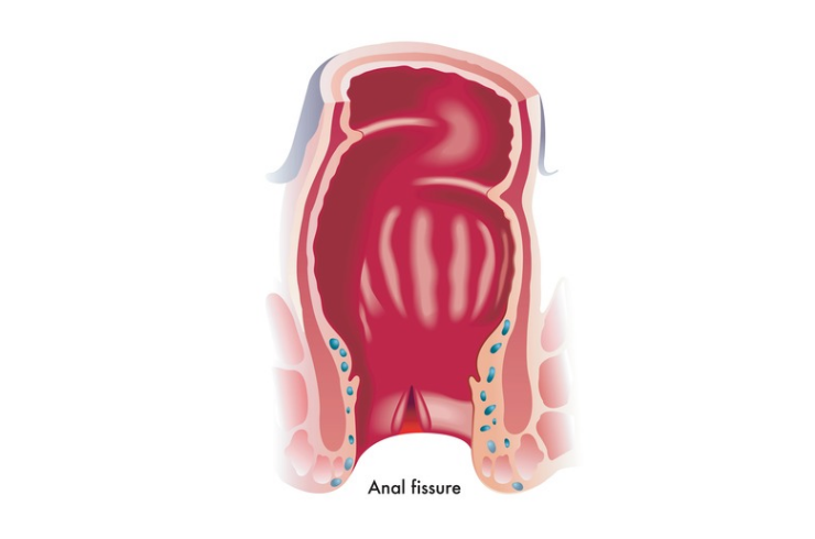Fissure Treatment